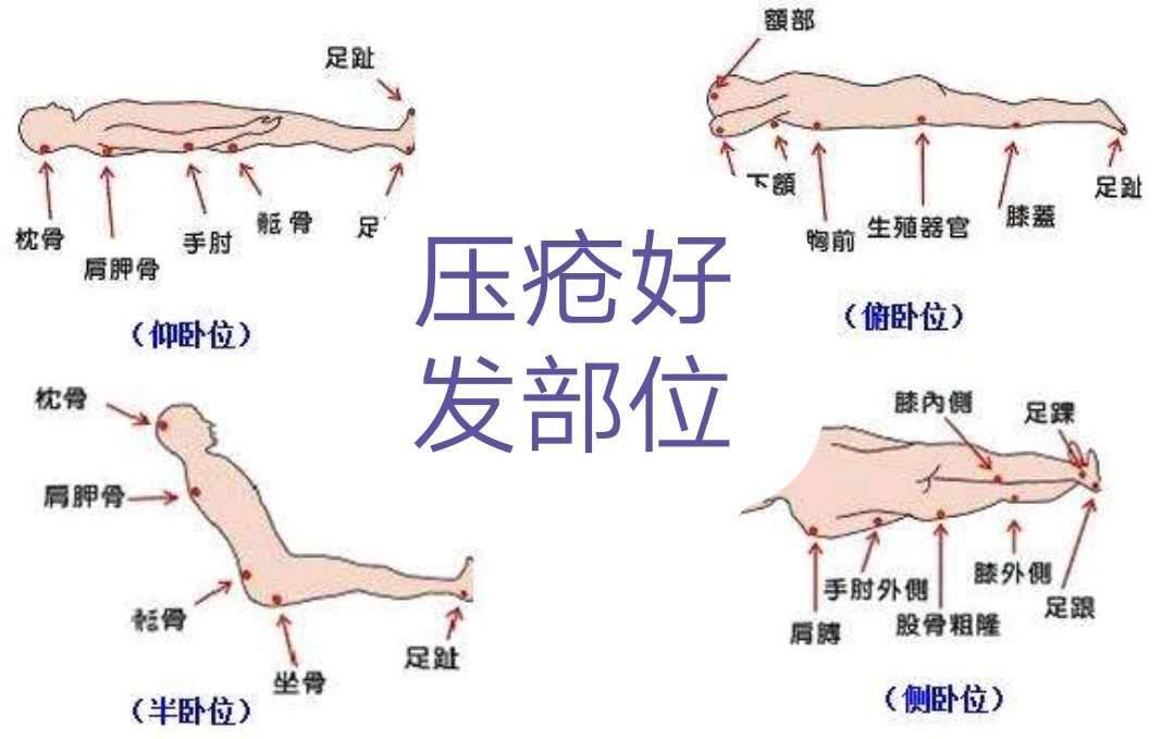 最新壓瘡護(hù)理措施的研究與應(yīng)用進(jìn)展